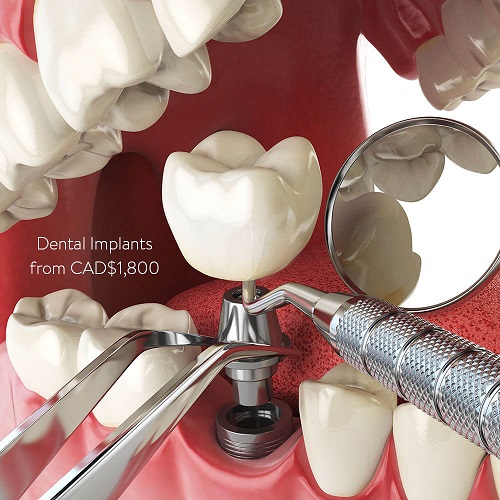 How much do Dental Implants cost? - Dentist Fairview Mall, North York