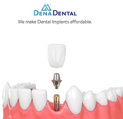 Dental Implants in North York near Fairview Mall